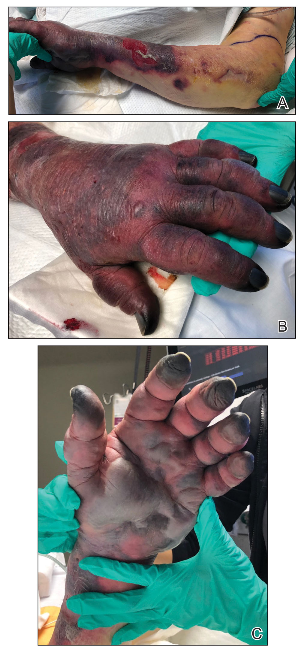 A, Resolution of erythema on the left proximal forearm to the elbow after the first administration of hyaluronidase. B, Left dorsal aspect of the hand. C, Persistence of dusky violaceous patches and necrotic bullae on the left palm. 