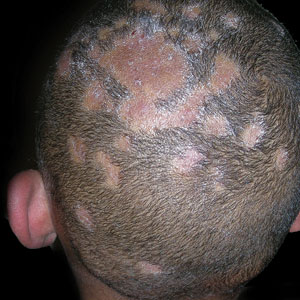 Tinea capitis