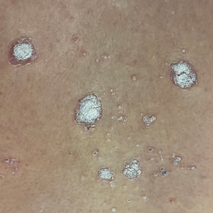 Scattered 2- to 5-mm, pink-erythematous, scaly plaques were present on the posterior trunk (back).