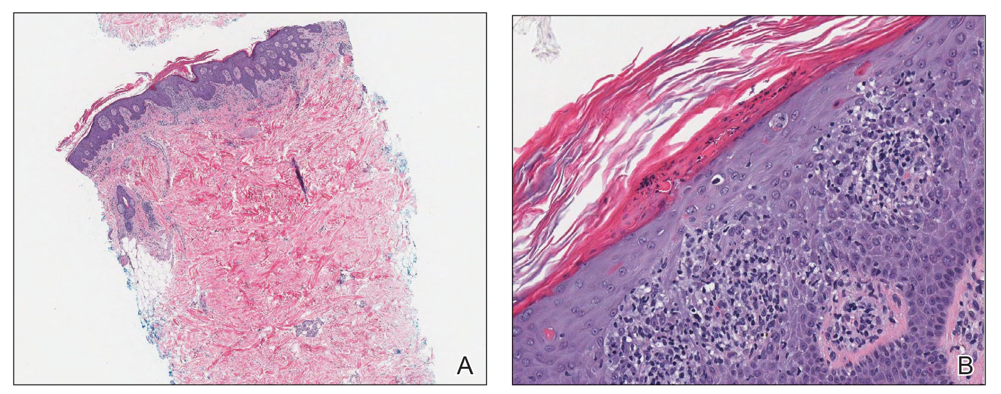 A, Histopathology of one of the lesions on the back showed mainly epidermal and superficial dermal involvement (H&E, original magnification ×40). B, Psoriasiform dermatitis with confluent parakeratosis and scattered necrotic keratinocytes also were noted 