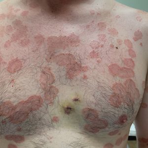 Painful and pruritic eruptions on the entire body