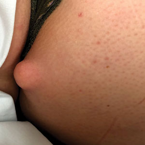 Pseudolipoma on the right buttock intergluteal fold.