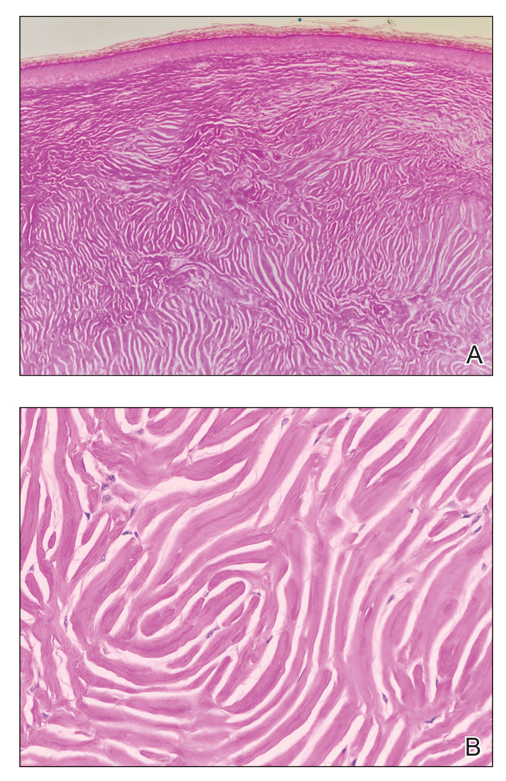 A, Unencapsulated dermal nodule with attenuated epidermis and a plywoodlike appearance (H&E, original magnification ×4). B, Thick and homogenized collagen bundles with prominent clefts and a whorled pattern (H&E, original magnification ×20).