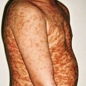 Itchy red-brown spots on a child