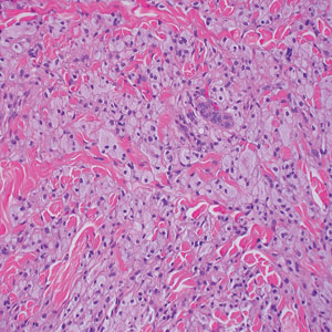 Juvenile xanthogranuloma. Mixed infiltrate with eosinophils, lipidized histiocytes, and Touton giant cells (H&E, original magnification ×200). Reference bar indicates 50 mm.