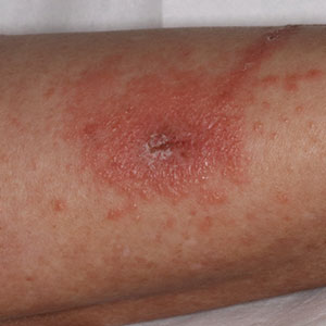 Erythematous vesicular rash with secondary crusting in a patient with Toxicodendron dermatitis.