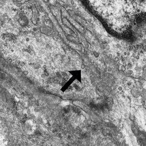 Electron microscopy showed long, slender, cytoplasmic processes coated by discontinuous basal lamina and the presence of many pinocytic vesicles (black arrow)(original magnification ×15,000).