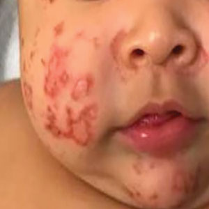 Annular and polycyclic, hyperkeratotic, crusted papules and plaques on the cheeks.