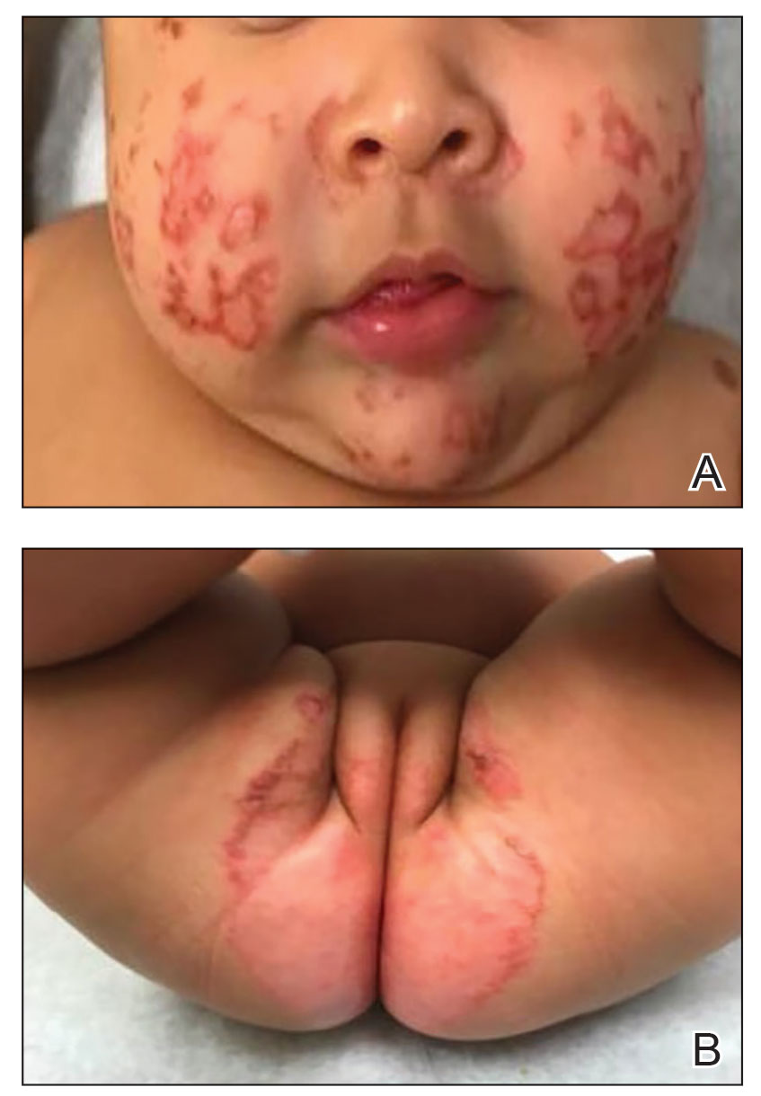 A, Annular and polycyclic, hyperkeratotic, crusted papules and plaques on the cheeks. B, Similar lesions were present in the perineum/groin and perianal regions.