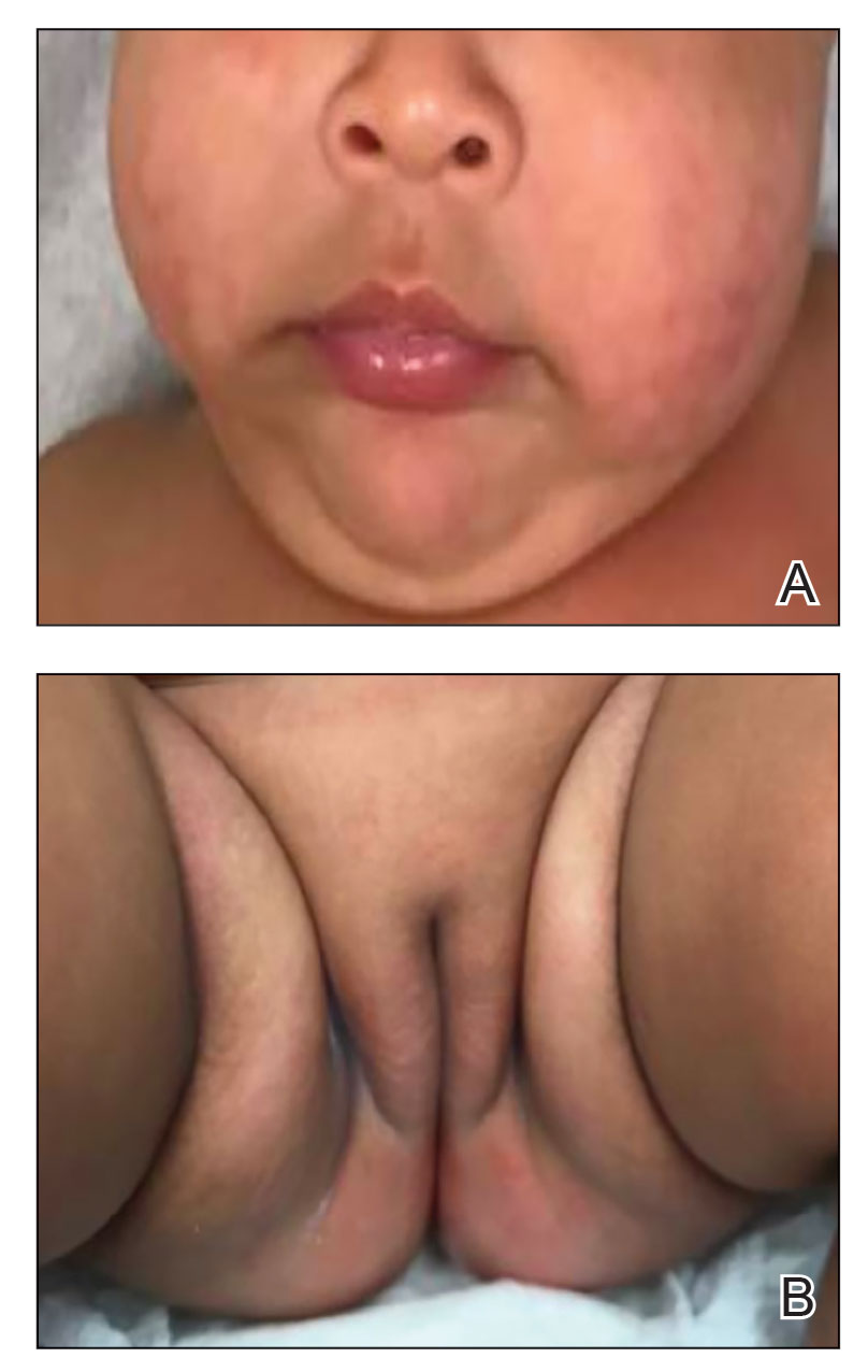 A, Three weeks after treatment with zinc supplementation, the annular crusted papules and plaques were no longer evident on the cheeks. B, The perineum/groin and perianal regions showed similar clearance.
