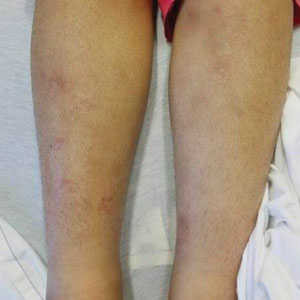 Scattered hyperpigmented scaly plaques with indurated nodules on the legs. 