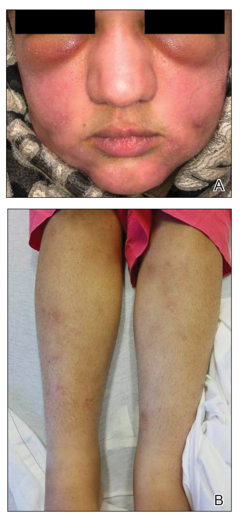A, Edema of the periorbital skin and cheeks, as well as pink scaly plaques on the cheeks and chin. B, Scattered hyperpigmented scaly plaques with indurated nodules on the legs. 