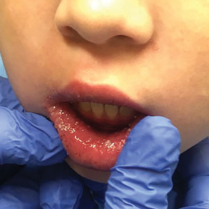 Confluent swelling of the upper and lower labial mucosa with white pustules and plaques over the upper and lower lips in a 7-year-old girl.