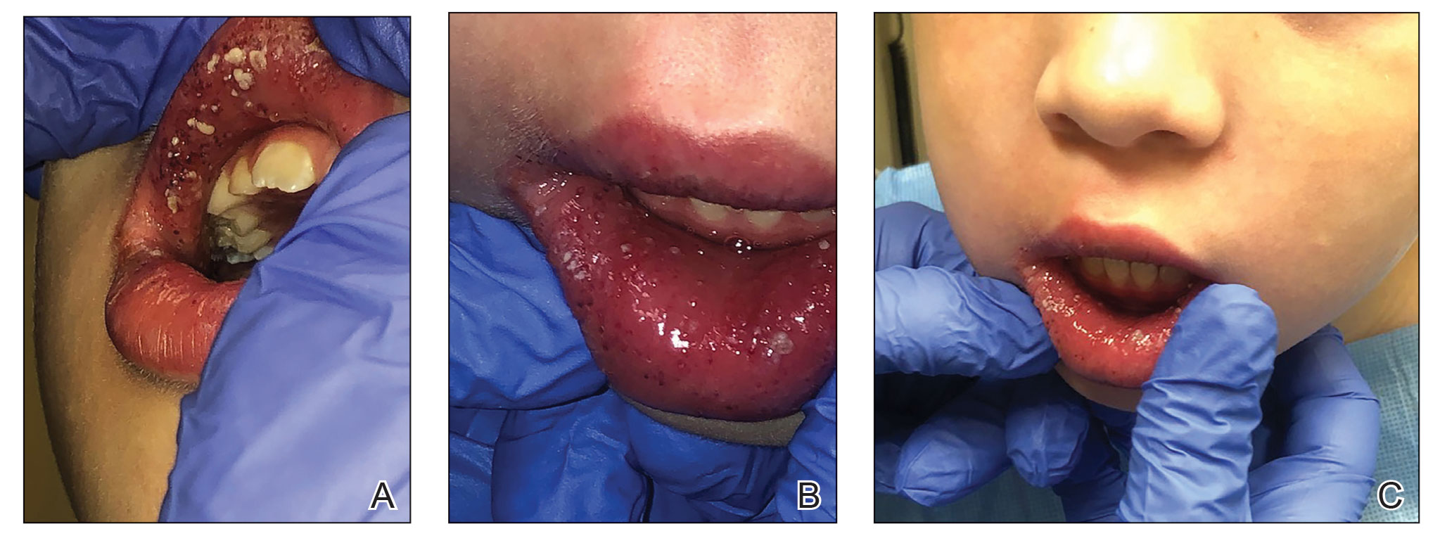 Confluent swelling of the upper and lower labial mucosa with white pustules and plaques over the upper and lower lips in a 7-year-old girl.
