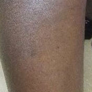 Diffuse dark brown to black patches on the superior right leg, which can be distinguished from the normal baseline color on the inferior portion of the lower extremity