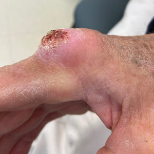 Atypical Keratotic Nodule on the Knuckle