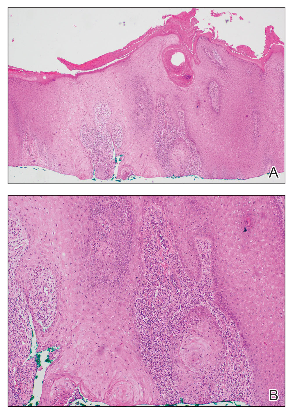 Shave biopsy sections demonstrated superficial portions of a squamous process with marked irregular acanthosis, cytologic atypia, and mixed inflammation involving the superficial dermis, suggestive of squamous cell carcinoma