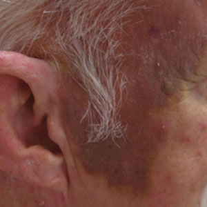 Cutaneous angiosarcoma at the time of diagnosis