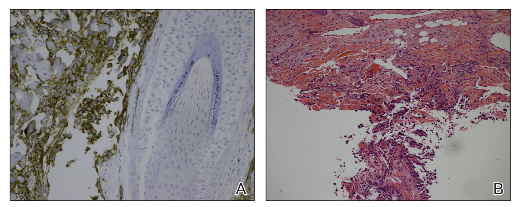 A, A punch biopsy of the right parietal scalp showed cytologically atypical endothelial cells forming slitlike vascular spaces in the dermis (H&E, original magnification ×100). B, Cytoplasmic CD31 staining of endothelial lining of slit-like atypical