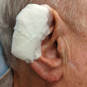 Pressure bandage on the ear, a traditionally hard-tobandage site. The elasticity of the tape conforms to the helical rim.