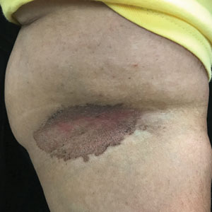 A well-demarcated, redbrown plaque with fine scale in the antecubital fossa of an obese Hispanic woman