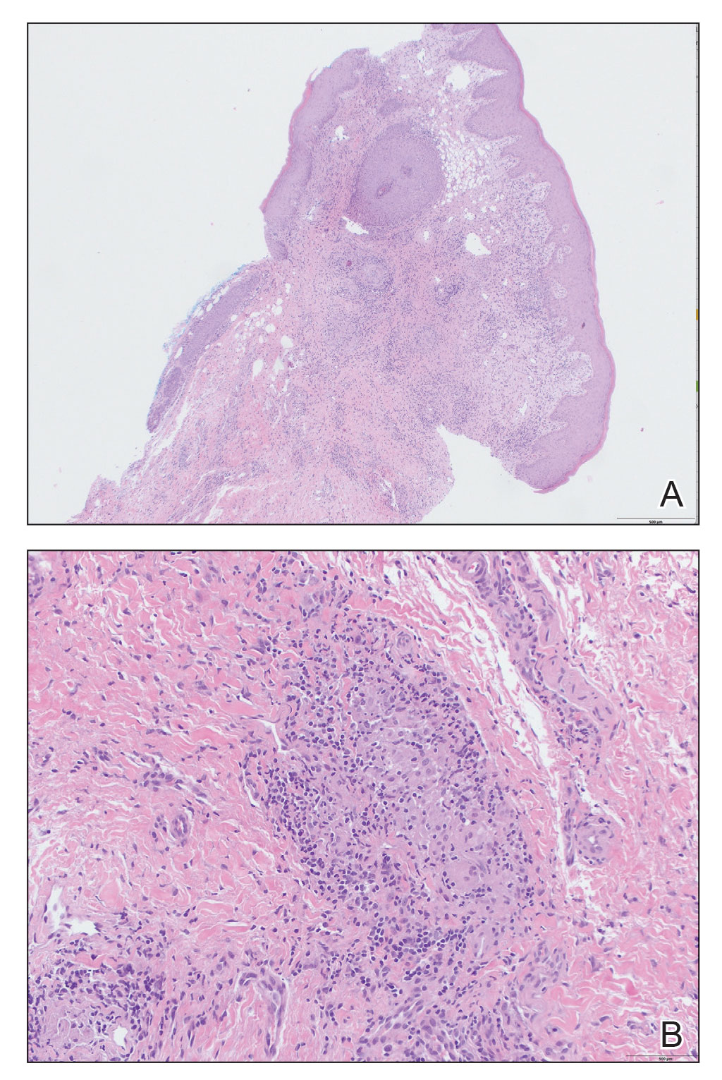 Histopathology of a biopsy from the right labia showed granulomatous dermatitis (H&E, original magnifications ×4 and ×20). Reference bars indicate 500 μm.