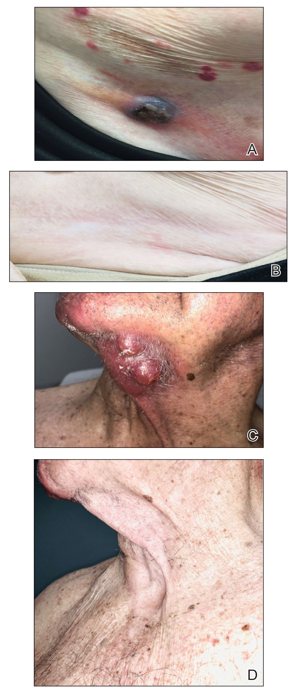 A, Patient 1 before treatment with the presence of a cutaneous T-cell lymphoma nodule near the inguinal crease. B, This patient showed complete response after 10 weeks of treatment with intralesional (IL) 5-fluorouracil (5-FU) and imiquimod.