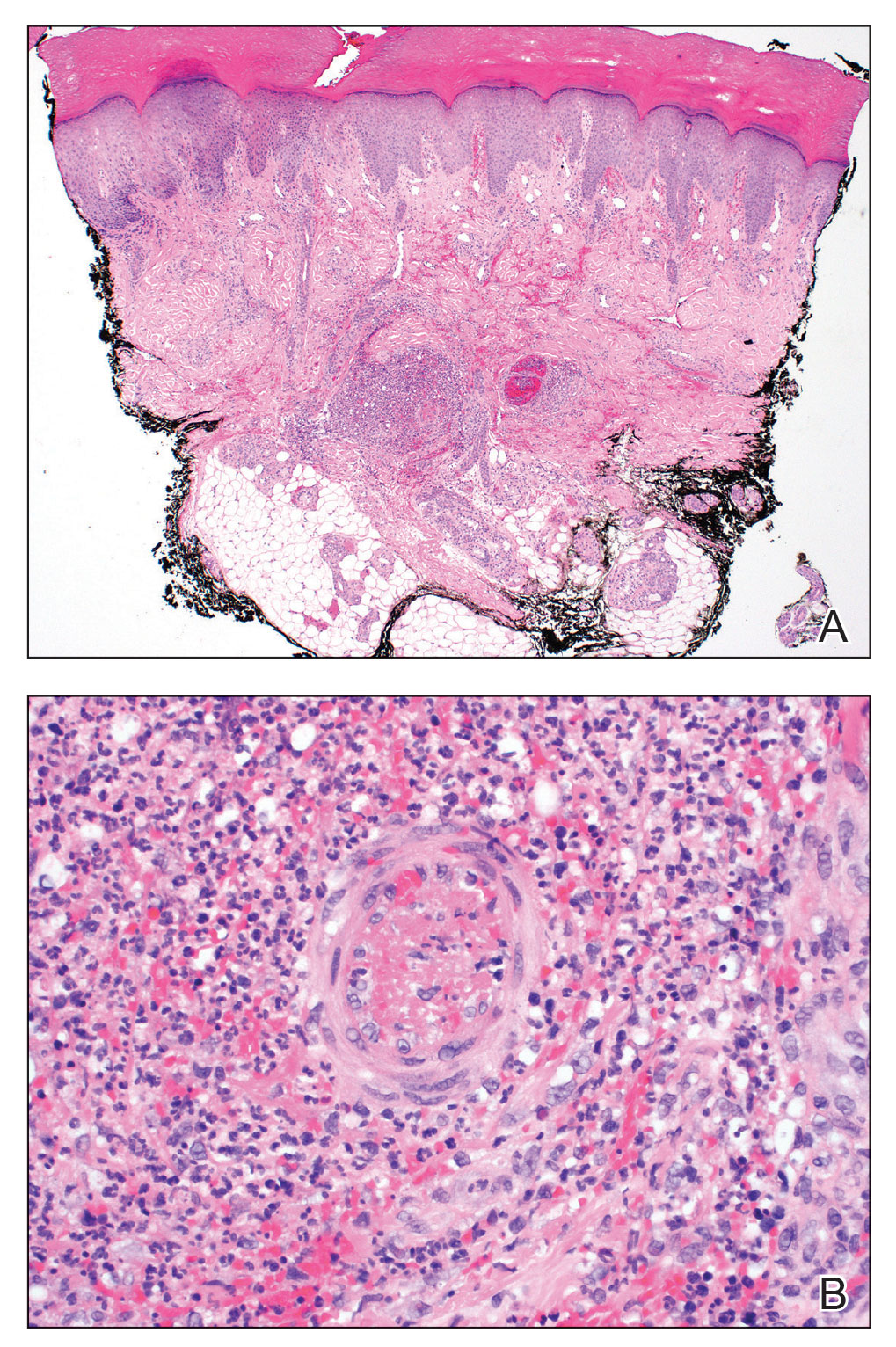 A, A punch biopsy of the left fourth finger pad revealed multiple intravascular microthrombi with edema and a dense perivascular neutrophilic infiltrate (H&E, original magnification ×40). B, Higher power showed a thrombus with surrounding fibrin...