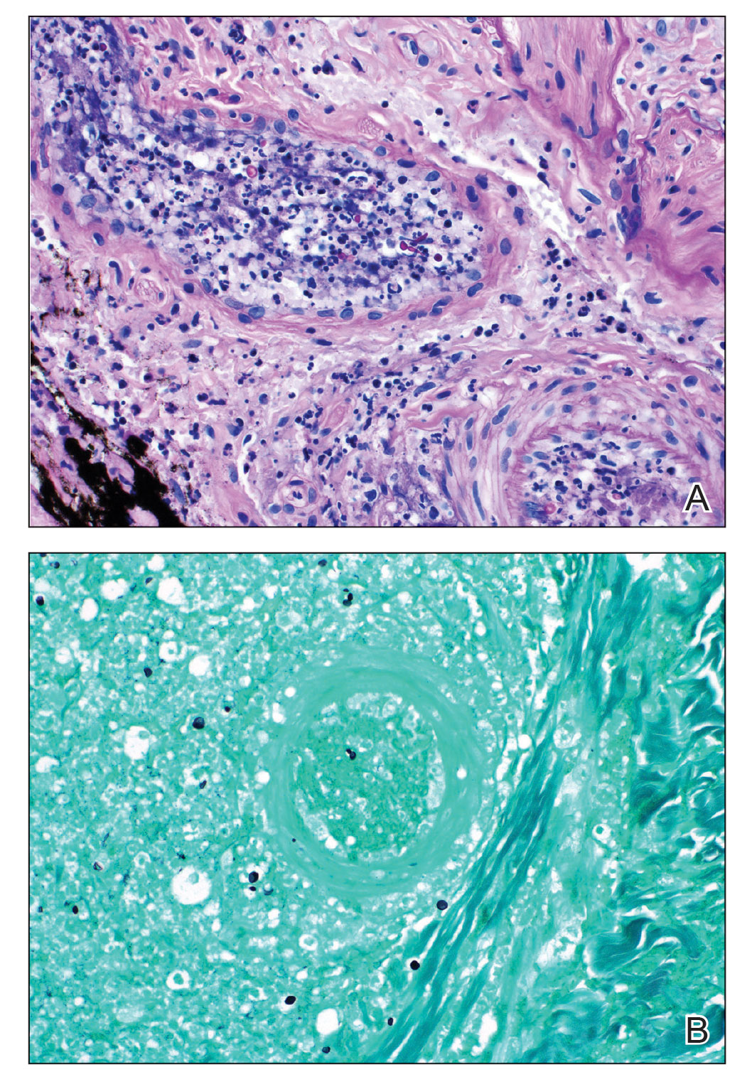  A, Periodic acid–Schiff stain highlighted fungal spores and pseudohyphae within the thrombosed vascular spaces (original magnification ×100). B, Grocott-Gomori methenamine-silver stain demonstrated fungal spores in the thrombosed vascular space