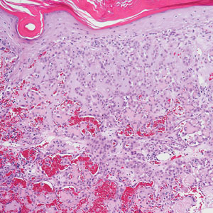 Rapidly growing nodule within a previously radiated area of the scalp