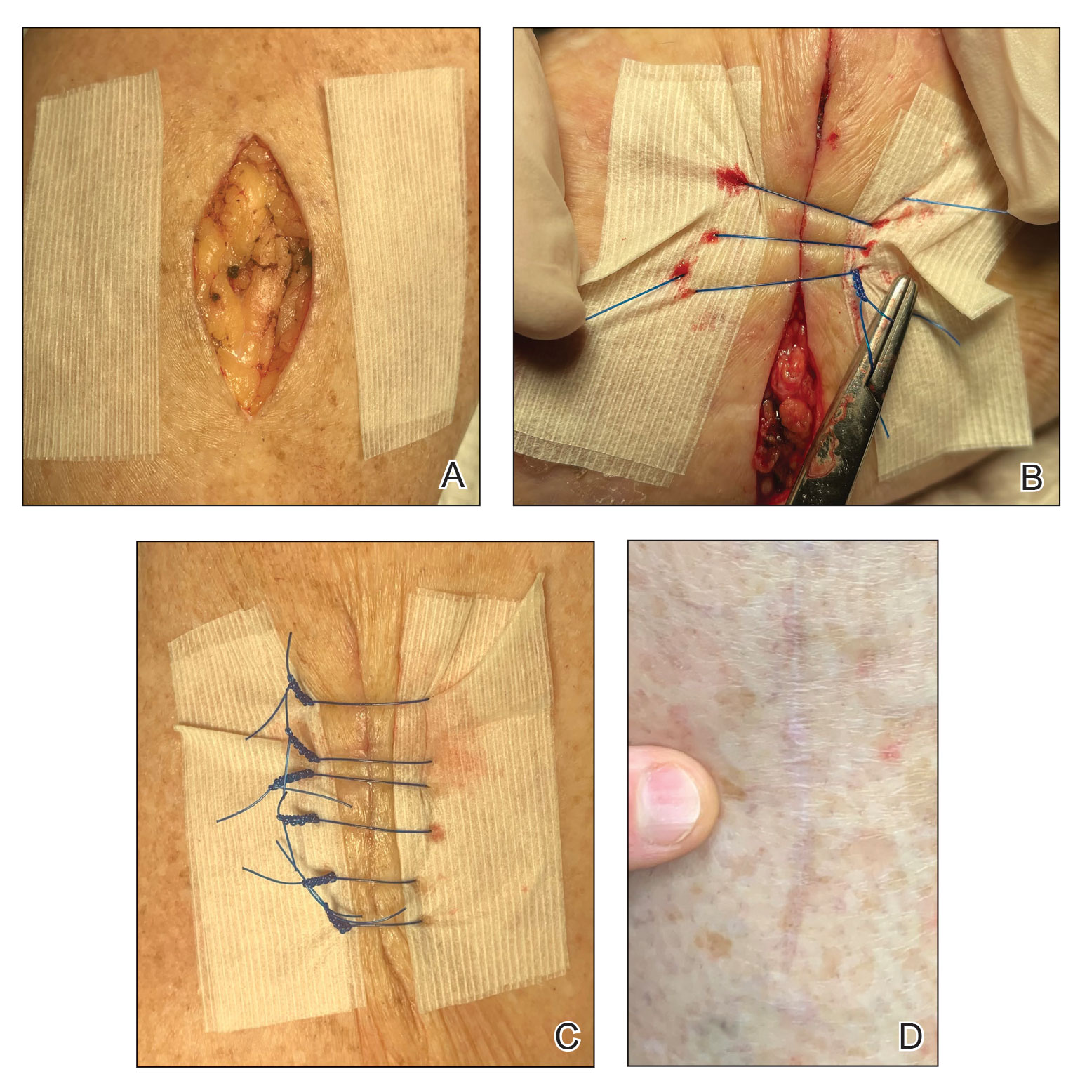 A typical ellipse following skin excision. In the initial setup, 2 layers of reinforced skin closure strips are placed parallel to the defect, approximately 1 cm from the edge of the wound