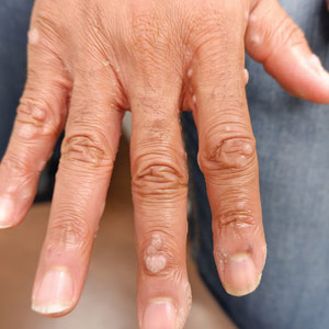 Verrucous flat papules on the dorsal surface of the patient’s hand. 