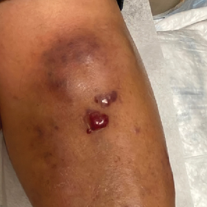 Violaceous nodules on the leg in a patient with HIV