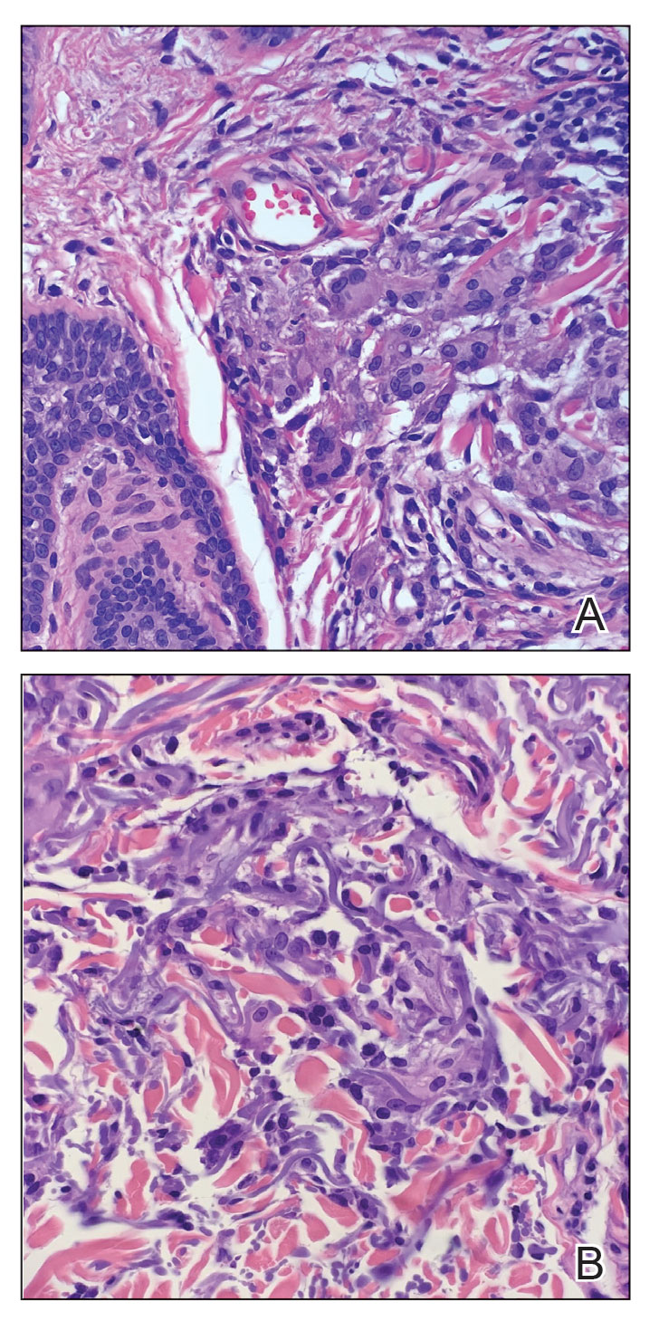 A biopsy showed basophilic elastic fibers in the cytoplasm of the multinucleated giant cells in the dermis (H&E, original magnifications ×400). Images courtesy of Anne Bussian, MD (Birmingham, Alabama).