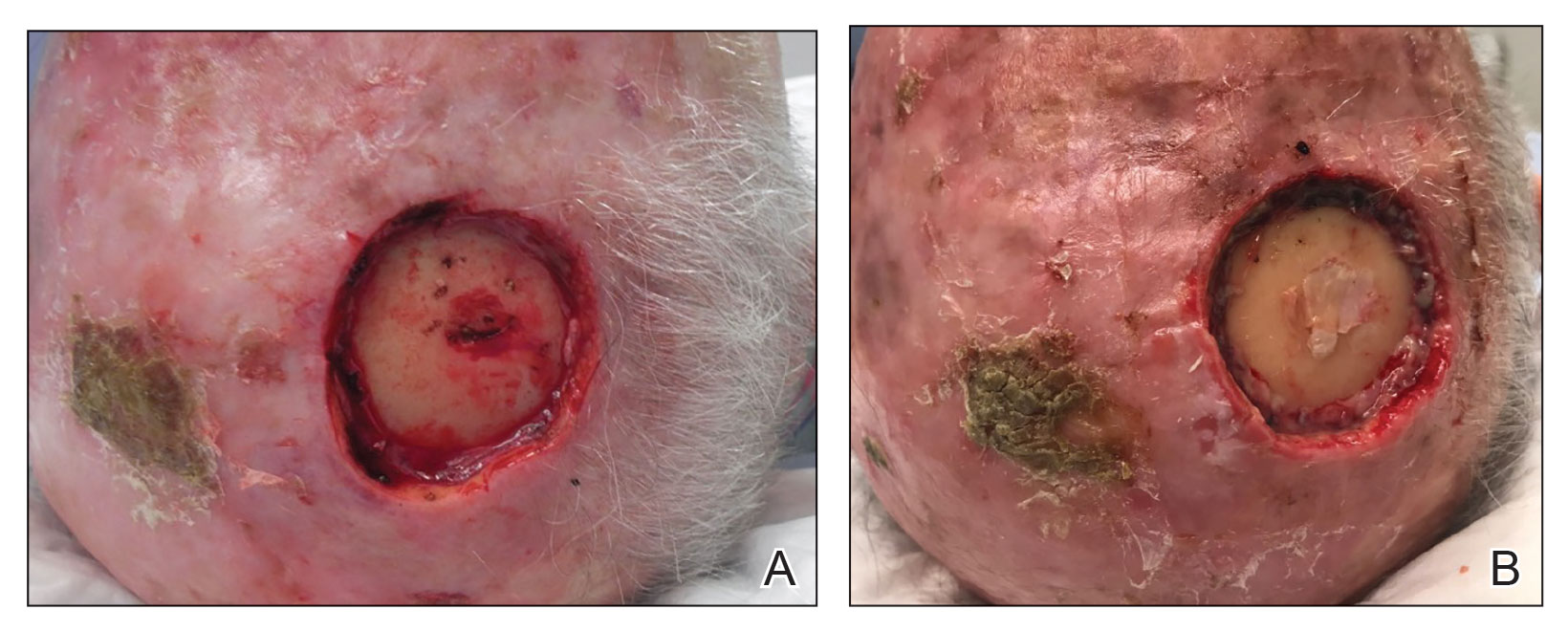 A, A bleeding surgical wound on the calvarium of the scalp. B, Bone wax in place and providing hemostasis at the bandage change.
