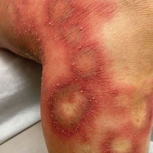 Scaly plaques coalesced into polycyclic plaques studded with nonfollicular-based pustules on the leg