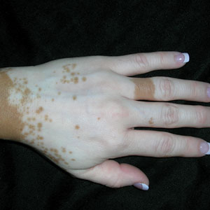 Vitiligo