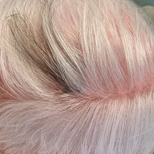 Localized darkening of hair on the left parietal scalp.