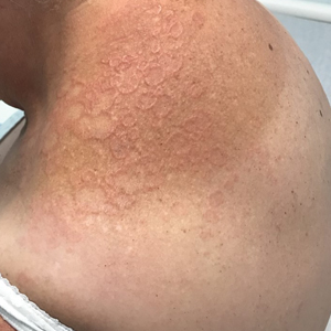 Annular erythematous plaques with central hypopigmentation on sun-exposed skin