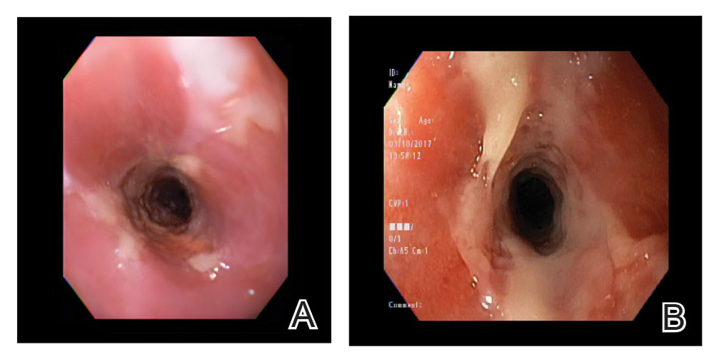 A, An endoscopy revealed esophageal erosions in the medial esophagus. B, A refractory esophageal stricture was noted in the medial esophagus.