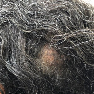  A 6.2×6.0-cm flesh-colored nodule on the scalp was examined prior to Mohs micrographic surgery.