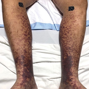 Retiform purpura on the lower legs