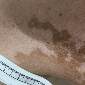 Diffuse hypopigmented patches noted on the patient’s trunk after nivolumab therapy.