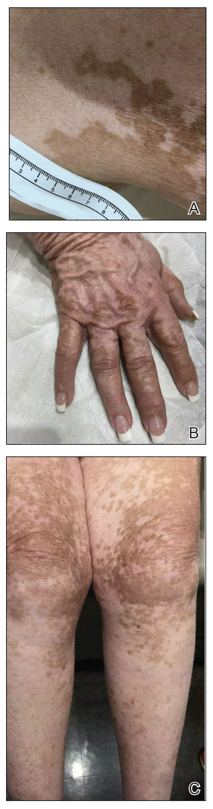 Diffuse hypopigmented patches noted on the patient’s trunk, hands, and legs after nivolumab therapy.