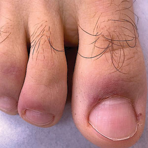 Chilblainlike lesions (so-called COVID toes) manifested with red-violaceous macules over the distal toes.