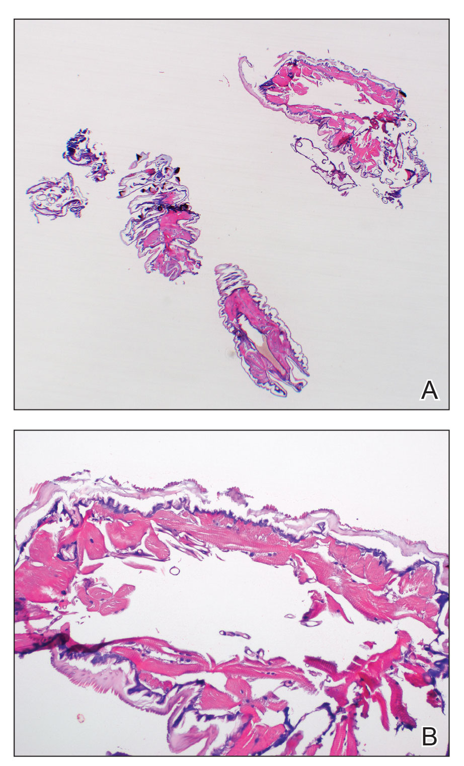 Histopathology showed an undulating chitinous exoskeleton and pigmented spines (setae) protruding from exoskeleton with associated superficial perivascular lymphohistiocytic infiltrates