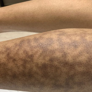 Biopsy-proven erythema ab igne in a patient with darker skin.