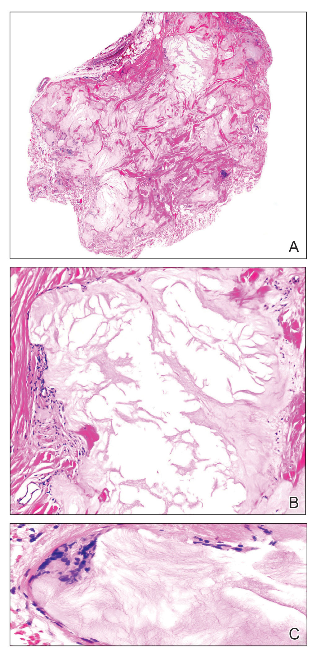 A, Low-power histopathology revealed nodular aggregates of acellular material with areas varying in color from pale to eosinophilic (H&E, original magnification ×2).