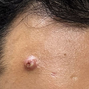 A pink papule with overlying pustules and crusting on the forehead.