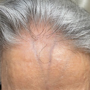 Lonely hair sign on the upper forehead in an older Middle Eastern patient with frontal fibrosing alopecia.